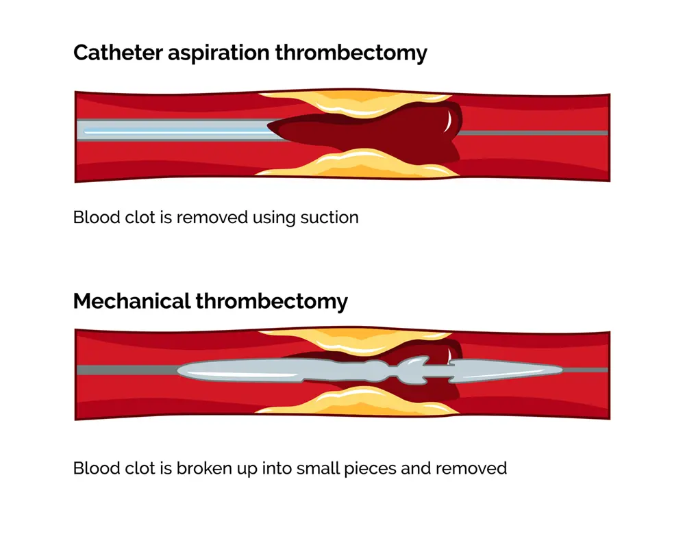 Thrombectomy